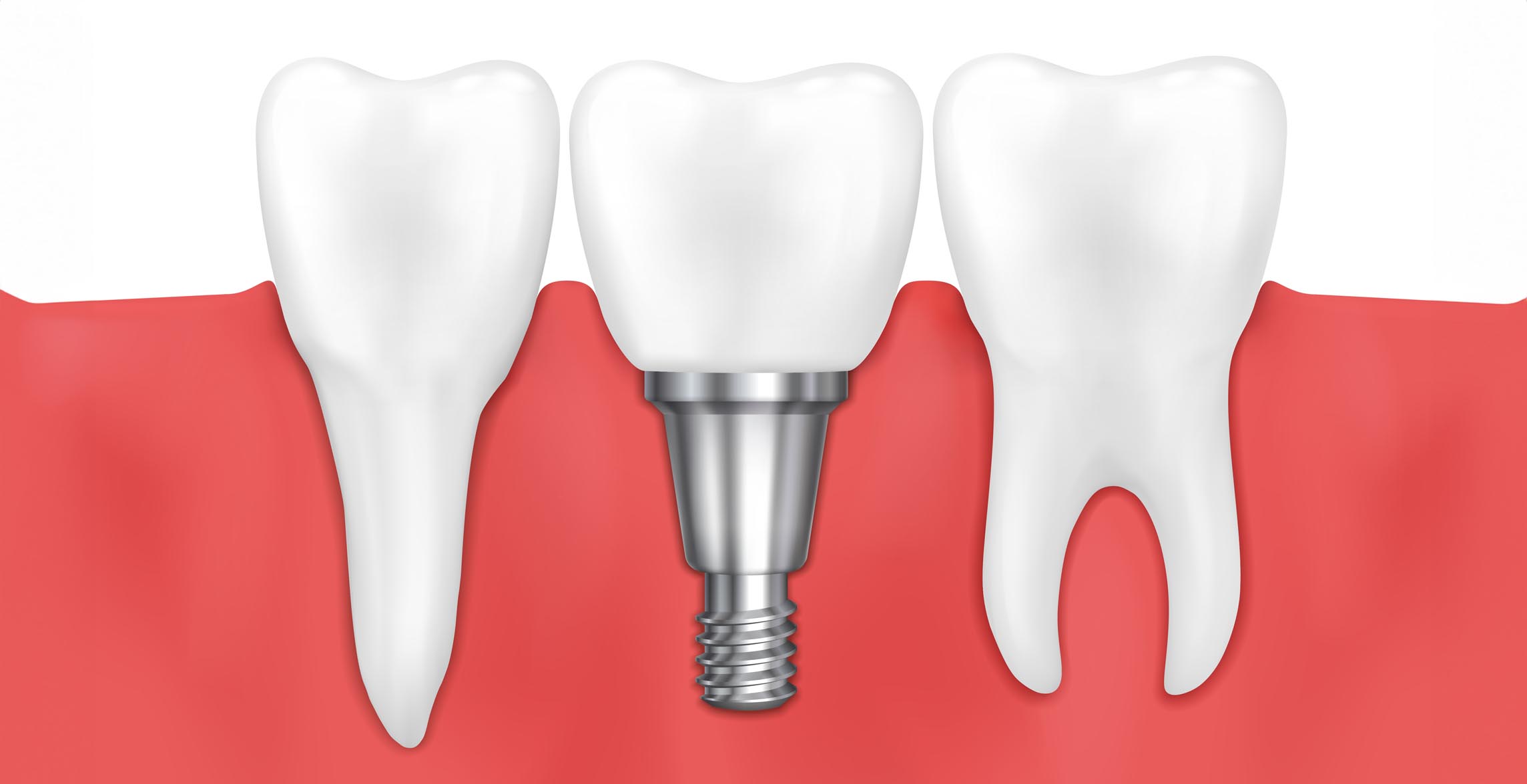 FIXED DENTAL BRIDGES ON IMPLANTS Small FIXED DENTAL BRIDGES ON IMPLANTS Small