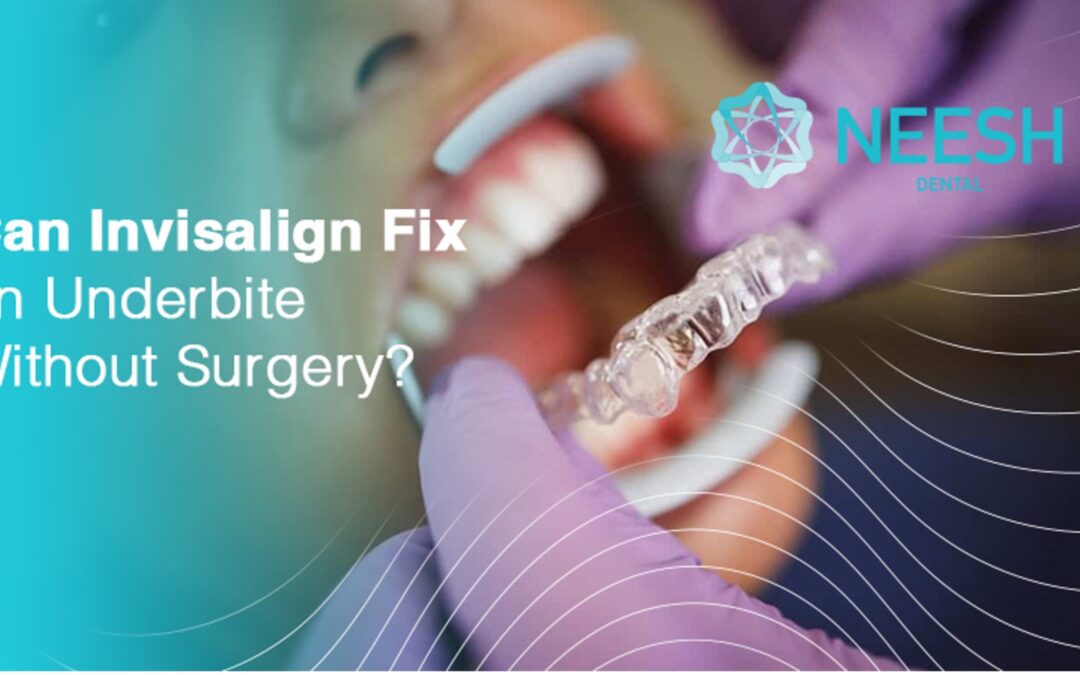 Can Invisalign Fix an Underbite Without Surgery?